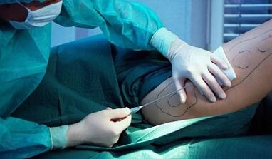 surgery to lose weight